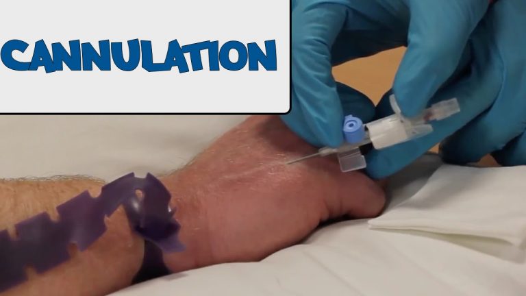 how to do cannulation osce gudie