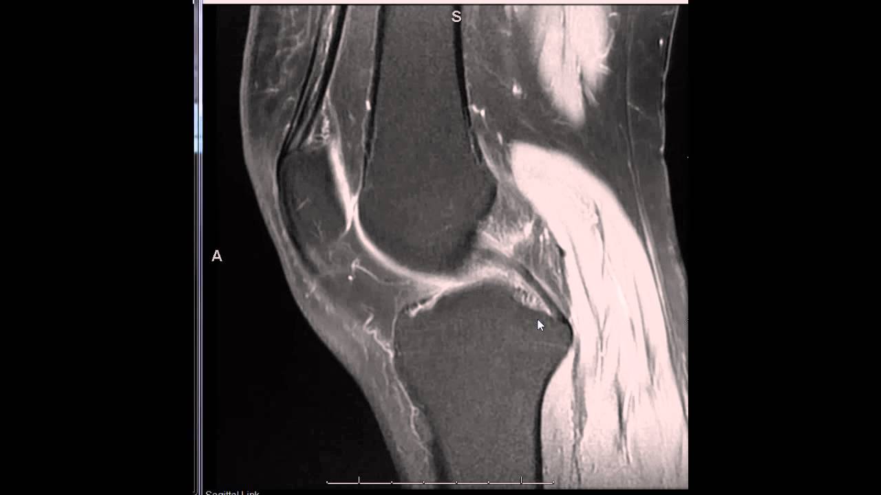 how to read mri of knee easily