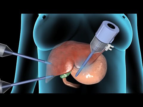 Lap Cholecystectomy Surgery animated Learning video