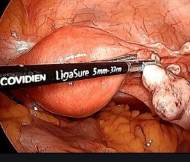 Total Laparoscopic Hysterectomy and Bilateral Salpingectomy with Ureteric Mapping using ICG 11 Screen Shot 2019 12 09 at 9.46.51 PM