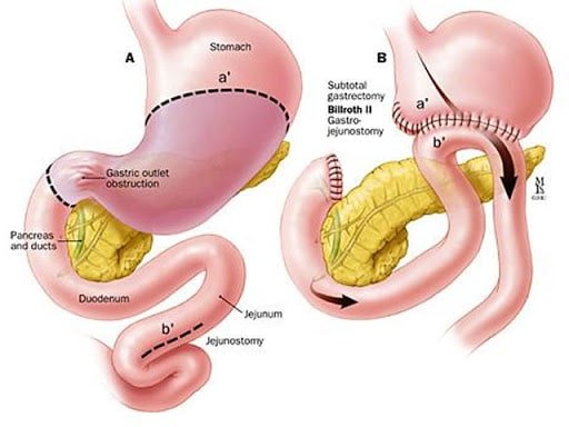 subtotal gastrectomy