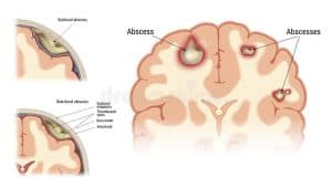 BRAIN ABSCESS - An Article in perspective to Physiotherapist