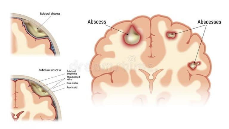 BRAINABSCESS PHYSIOTHERAPY