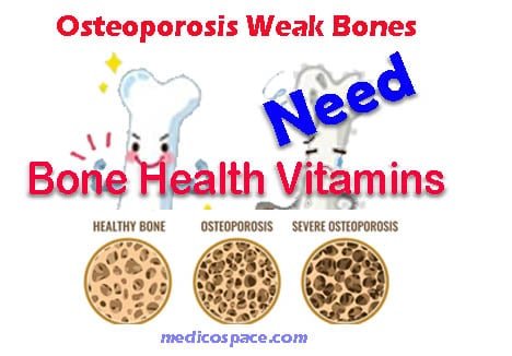 Osteoporosis Weak Bones need Bone Health Vitamins
