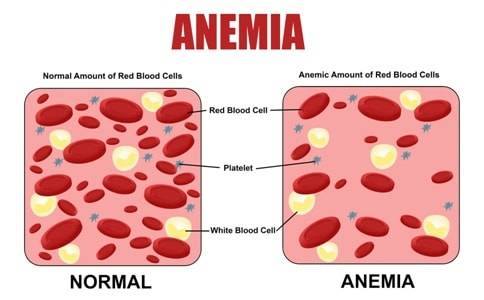 Know the Basics Prevention and Treatment of Anemia