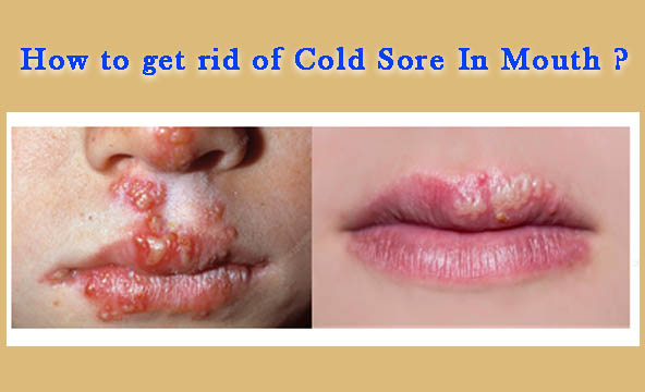 Ways to get rid of herpes bumps