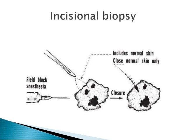 How to take incisional Biopsy correctly