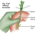 Trans-Duodenal Approcah for CBD Stones