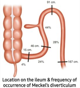 frequency of occurrence of #Meckel’s diverticulum & 8/2 Rule :Location on the ileum