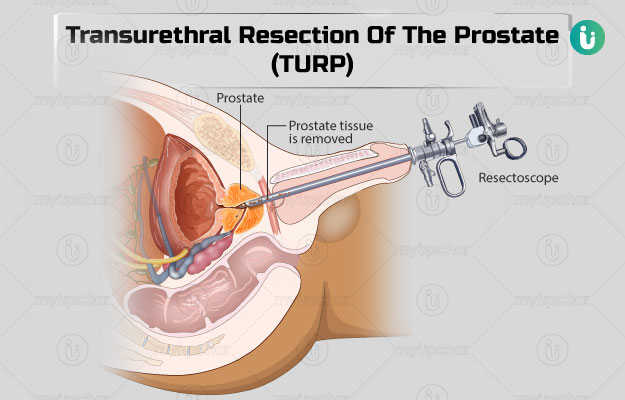 Informed Consent in URO: Transurethral Resection of the Prostate