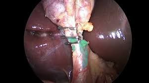 Laparoscopic Beginners - Video for Gall stone removal procedure.