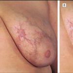 Diffuse Dermal Angiomatosis of the Breast