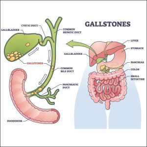Gall Stone Disease - Cholelithiasis 1 Gall Stone Disease - Cholelithiasis